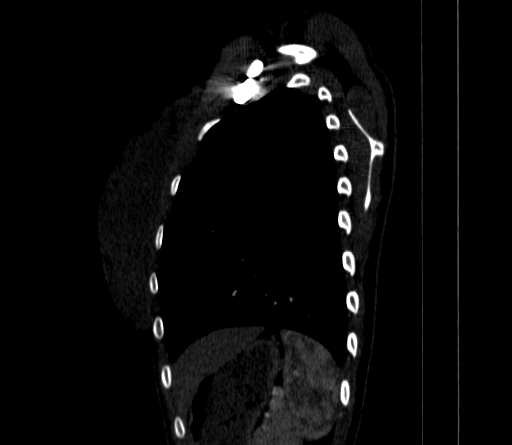 Arteria lusoria (Radiopaedia 88528-105192 C 74).jpg