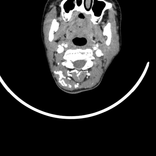 Arteriovenous malformation of the neck (Radiopaedia 53935-60062 A 49).jpg