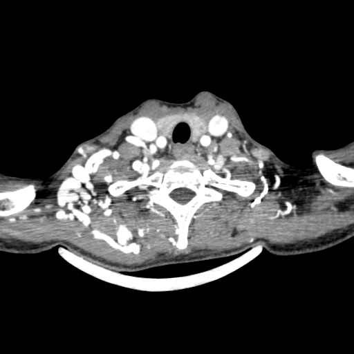 Arteriovenous malformation of the neck (Radiopaedia 53935-60062 A 6).jpg