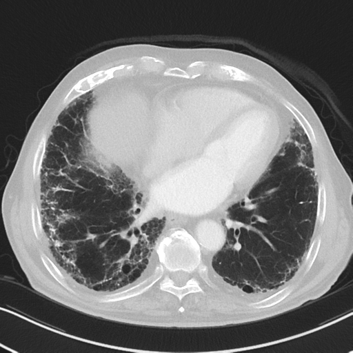 File:Asbestosis (Radiopaedia 56192-62864 Axial lung window 43).png