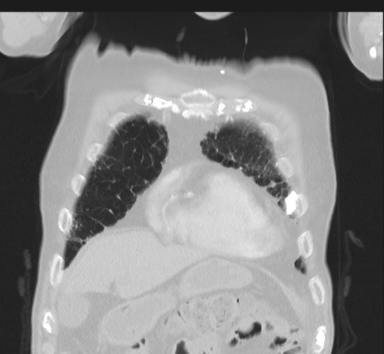 Asbestosis (Radiopaedia 56192-62864 Coronal lung window 11).png