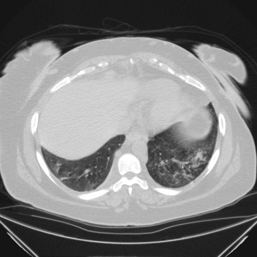 Aspergilloma (Radiopaedia 39611-41932 Axial lung window 105).jpg