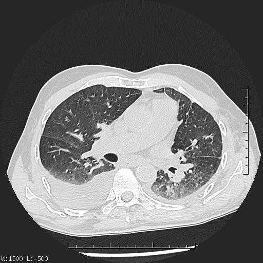 Aspergilloma (Radiopaedia 75184-86270 Axial lung window 24).jpg