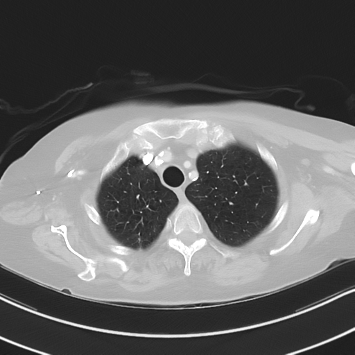 Aspiration bronchiolitis (Radiopaedia 53464-59463 Axial lung window 10).png