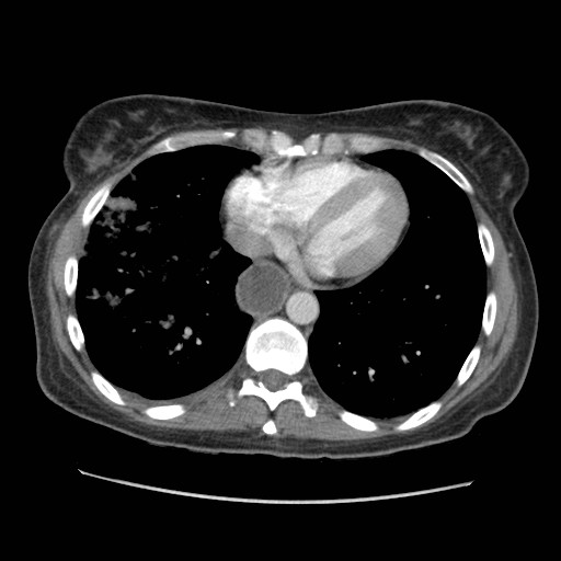Aspiration pneumonia secondary to laparoscopic banding (Radiopaedia 18345-18183 A 37).jpg