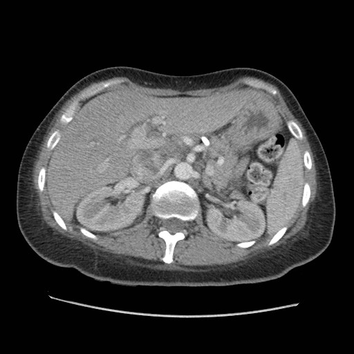 File:Aspiration pneumonia secondary to laparoscopic banding (Radiopaedia 18345-18183 A 56).jpg