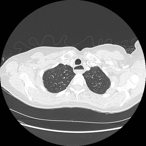 File:Aspiration pneumonia secondary to laparoscopic banding (Radiopaedia 18345-18183 lung window 11).jpg