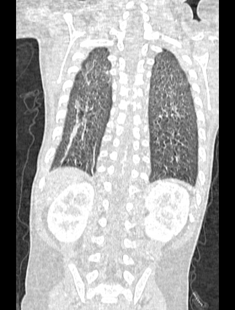 Asplenia syndrome (Radiopaedia 73083-83792 Coronal lung window 113).jpg