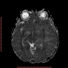 Astroblastoma (Radiopaedia 74287-85162 Axial ADC 25).jpg