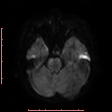 Astroblastoma (Radiopaedia 74287-85162 Axial DWI 28).jpg
