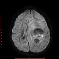 Astroblastoma (Radiopaedia 74287-85162 Axial DWI 64).jpg