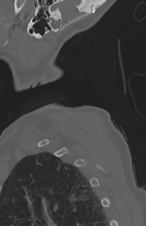 Atlanto-axial subluxation (Radiopaedia 36610-38176 Sagittal bone window 75).png