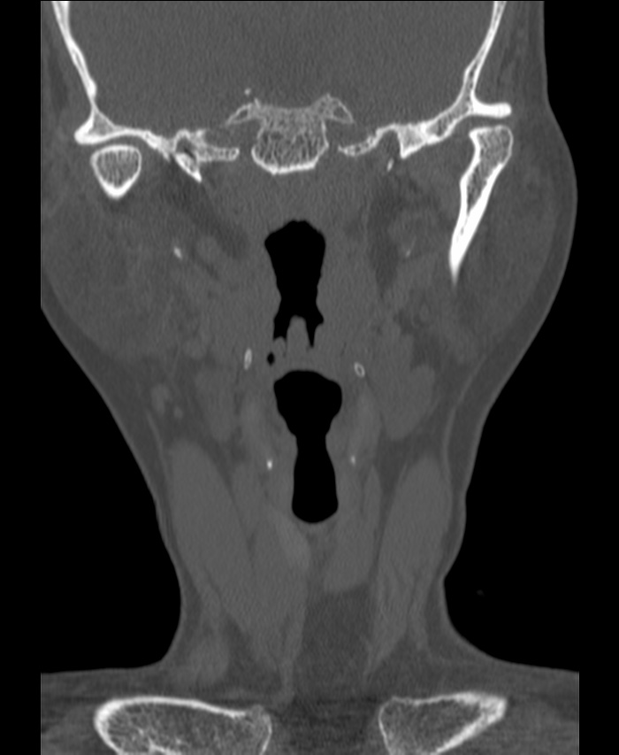 Atlanto-occipital assimilation with basilar invagination (Radiopaedia 70122-80188 Coronal bone window 7).jpg