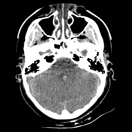 File:Atlanto-occipital dislocation (Radiopaedia 44648-48412 Axial non-contrast 16).jpg