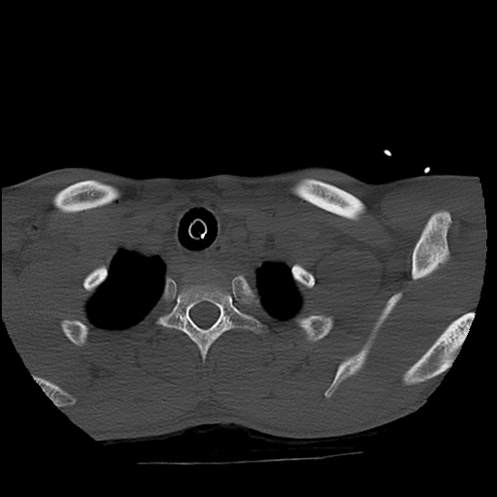Atlanto-occipital dissociation (Traynelis type 1), C2 teardrop fracture, C6-7 facet joint dislocation (Radiopaedia 87655-104061 Axial bone window 93).jpg