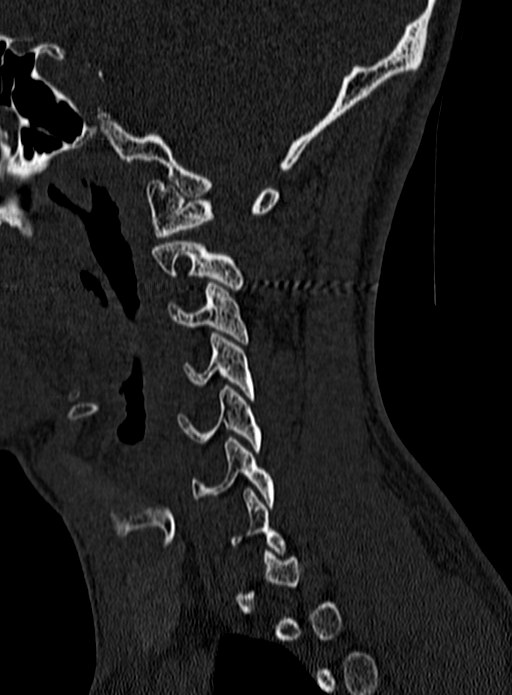 Atlantoaxial subluxation (Radiopaedia 44681-48450 Sagittal bone window 11).jpg