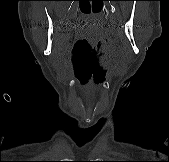 Atlas (type 3b subtype 1) and axis (Anderson and D'Alonzo type 3, Roy-Camille type 2) fractures (Radiopaedia 88043-104607 Coronal bone window 3).jpg