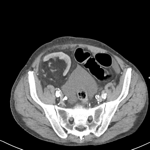 Atraumatic splenic rupture (Radiopaedia 42931-46160 A 67).png