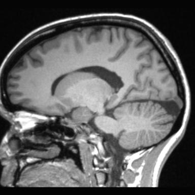 Atretic encephalocoele with inferior vermis hypoplasia (Radiopaedia 30443-31108 Sagittal T1 79).jpg