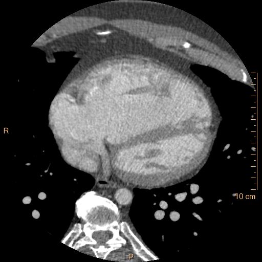Atrial septal defect (upper sinus venosus type) with partial anomalous pulmonary venous return into superior vena cava (Radiopaedia 73228-83961 A 192).jpg