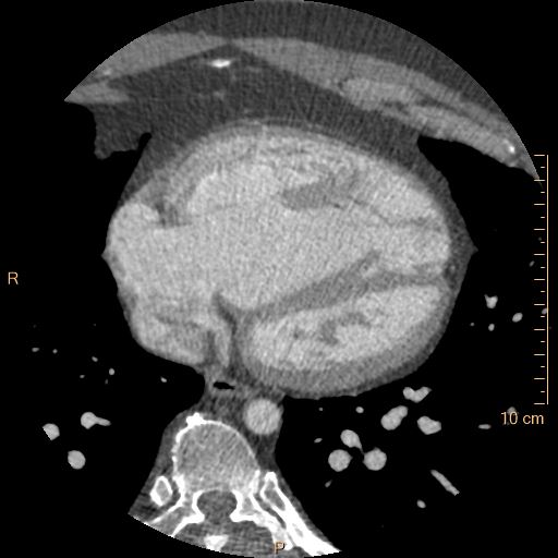 Atrial septal defect (upper sinus venosus type) with partial anomalous pulmonary venous return into superior vena cava (Radiopaedia 73228-83961 A 198).jpg