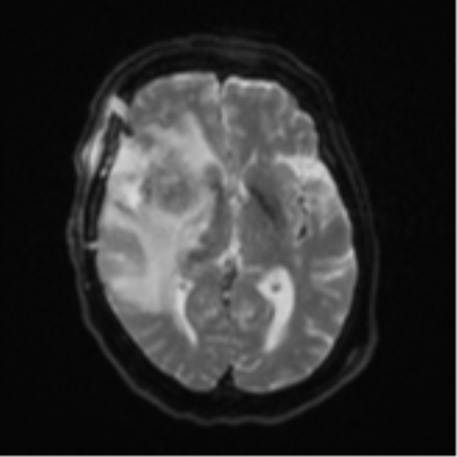Atypical meningioma (WHO Grade II) (Radiopaedia 54742-60981 Axial DWI 14).png
