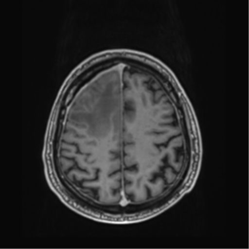 File:Atypical meningioma (WHO grade II) with brain invasion (Radiopaedia 57767-64729 Axial T1 C+ 38).png