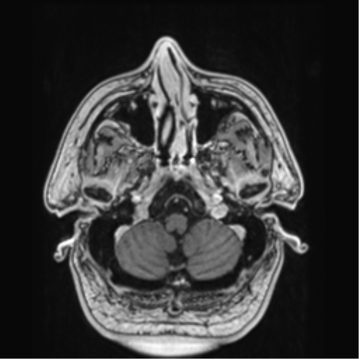 File:Atypical meningioma (WHO grade II) with brain invasion (Radiopaedia 57767-64729 Axial T1 C+ 6).png