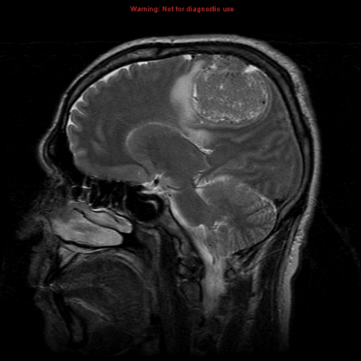 File:Atypical meningioma - grade II (Radiopaedia 13303-13305 Sagittal T2 10).jpg