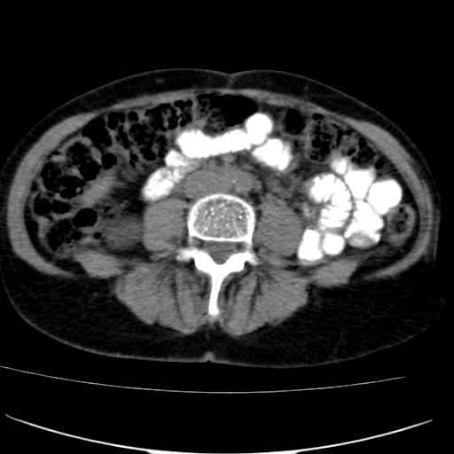 File:Atypical renal cyst (Radiopaedia 17536-17251 non-contrast 28).jpg