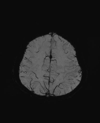 Autoimmune limbic encephalitis (Radiopaedia 30363-31005 SWI - mIP 57).jpg