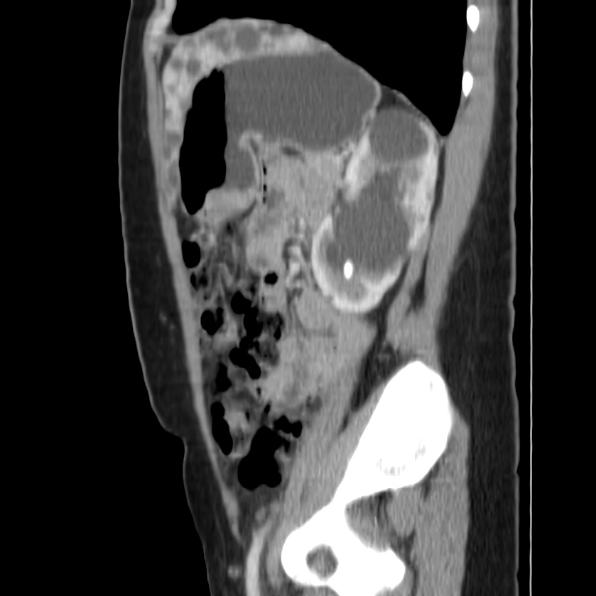 Autosomal dominant polycystic kidney disease (Radiopaedia 23061-23093 F 40).jpg