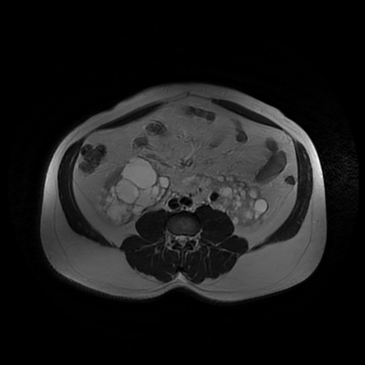File:Autosomal dominant polycystic kidney disease (Radiopaedia 50259-55611 Axial T2 31).jpg