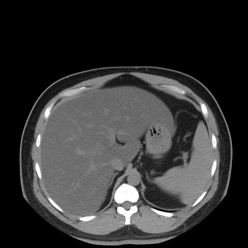 Autosomal dominant polycystic kidney disease (Radiopaedia 50259-55612 Axial non-contrast 23).jpg