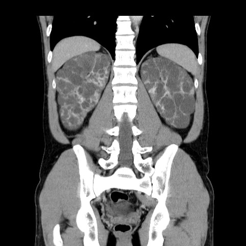 Autosomal dominant polycystic kidney disease (Radiopaedia 66349-75582 A 64).jpg