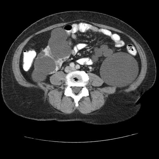 Autosomal dominant polycystic kidney disease with hepatic involvement (Radiopaedia 32693-33662 B 51).jpg