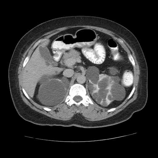 Autosomal dominant polycystic kidney disease with hepatic involvement (Radiopaedia 32693-33662 C 25).jpg