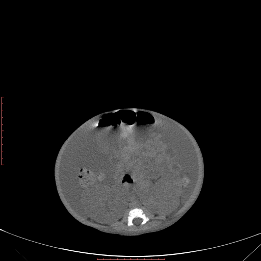 Autosomal recessive polycystic kidney disease associated with Caroli disease (Radiopaedia 61932-69984 Axial non-contrast 236).jpg