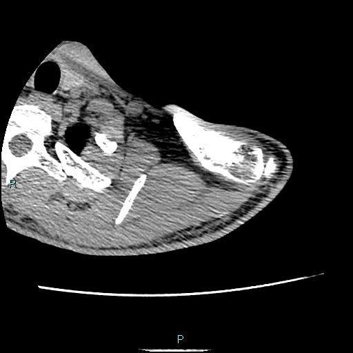 File:Avascular necrosis after fracture dislocations of the proximal humerus (Radiopaedia 88078-104653 D 14).jpg