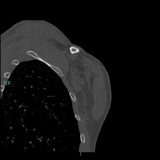 Avascular necrosis after fracture dislocations of the proximal humerus (Radiopaedia 88078-104655 Coronal bone window 121).jpg