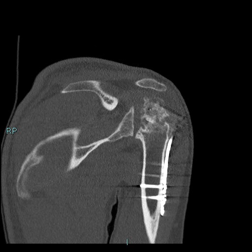 Avascular necrosis after fracture dislocations of the proximal humerus (Radiopaedia 88078-104655 Coronal bone window 66).jpg
