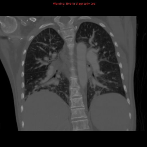 Avascular necrosis in sickle cell disease (Radiopaedia 17448-17152 Coronal bone window 82).jpg