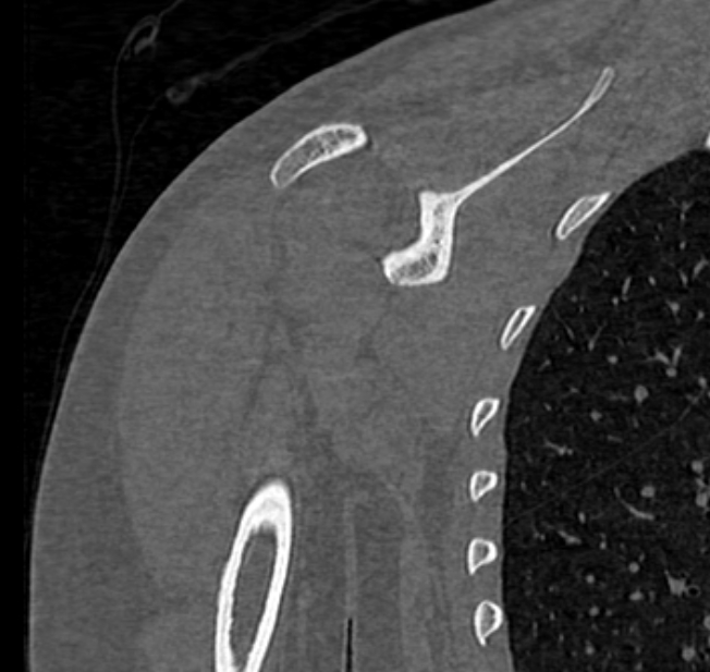 Avulsion fracture - greater tuberosity of humerus (Radiopaedia 71216-81514 Coronal bone window 43).jpg