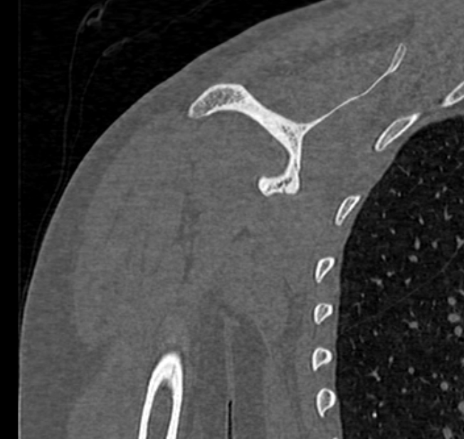 Avulsion fracture - greater tuberosity of humerus (Radiopaedia 71216-81514 Coronal bone window 47).jpg