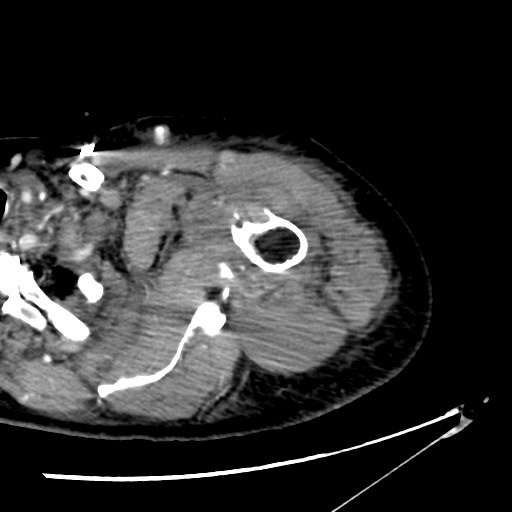 File:Axillary arterial pseudoaneurysm (Radiopaedia 24925-25195 A 1).jpg