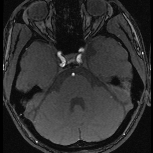 File:Azygos anterior cerebral artery (Radiopaedia 17059-16756 Axial MRA 59).jpg