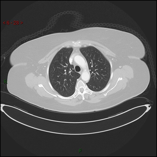 Azygos fissure and lobe (Radiopaedia 47620-52278 Axial lung window 28).jpg