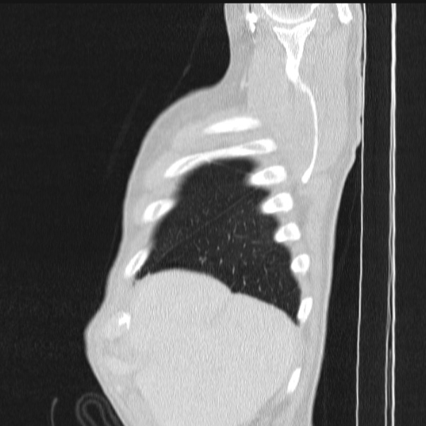 Azygos lobe (Radiopaedia 38259-40275 lung window 13).jpg