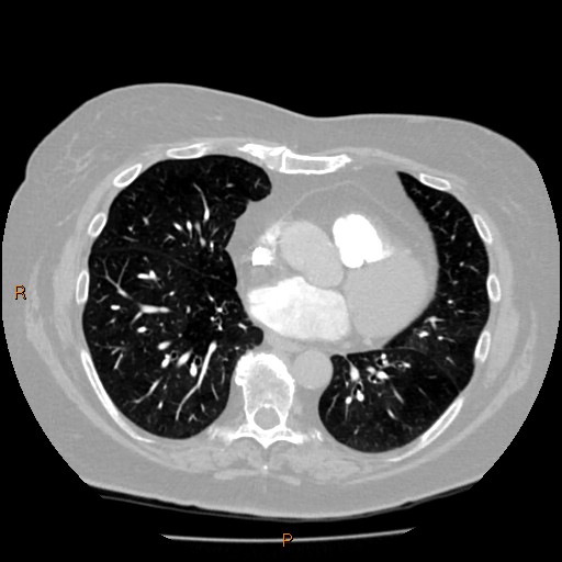 Azygos lobe (Radiopaedia 40161-42821 Axial lung window 44).jpg