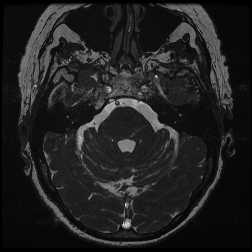 File:Balo concentric sclerosis (Radiopaedia 53875-59982 Axial T2 FIESTA 47).jpg